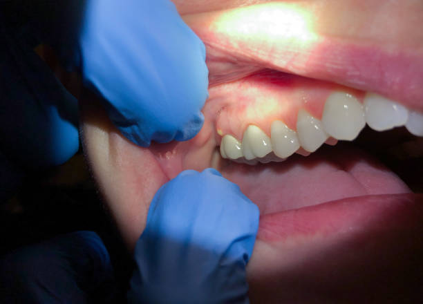 Best Emergency Tooth Extraction in Lake Dallas, TX
