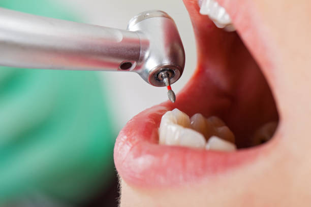 Best Emergency Root Canal Treatment in Lake Dallas, TX